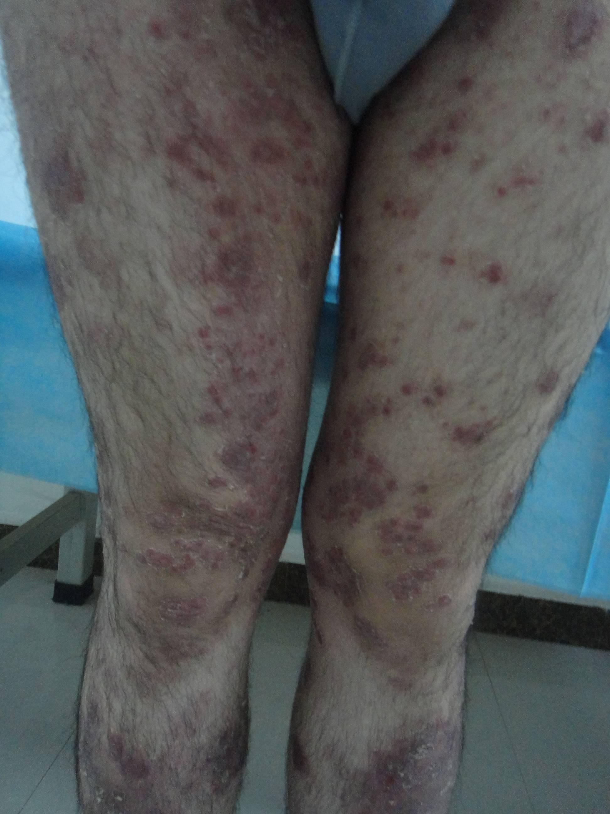 脓疱型牛皮癣怎样护理