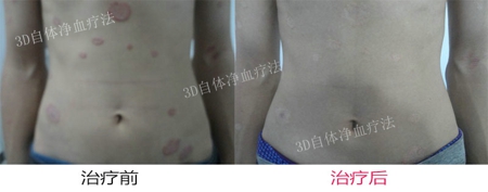 红皮型银屑病治疗方法有哪些